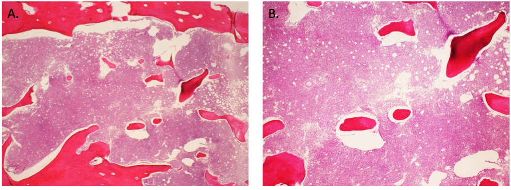 Figures 1A and 1B. Extensive involvement of bilateral maxillary condyles by an diffuse atypical cell infiltrates.